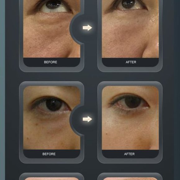 RF lifting home care device - Picture 4 of 9